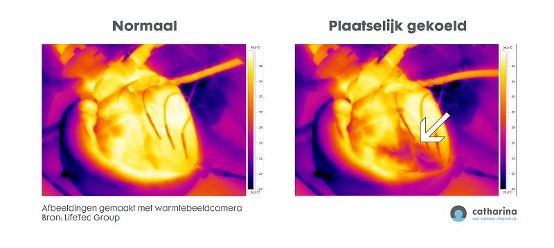 Normaal en gekoeld hart Catharina Ziekenhuis