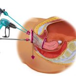 Gynaecologen Catharina Ziekenhuis hebben Brabantse primeur met nieuwe operatietechniek