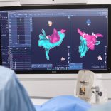 Primeur: Catharina gebruikt als eerste in Nederland nieuwe techniek voor de behandeling van boezemfibrilleren