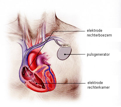 031 hart met twee elektroden en ICD.jpg