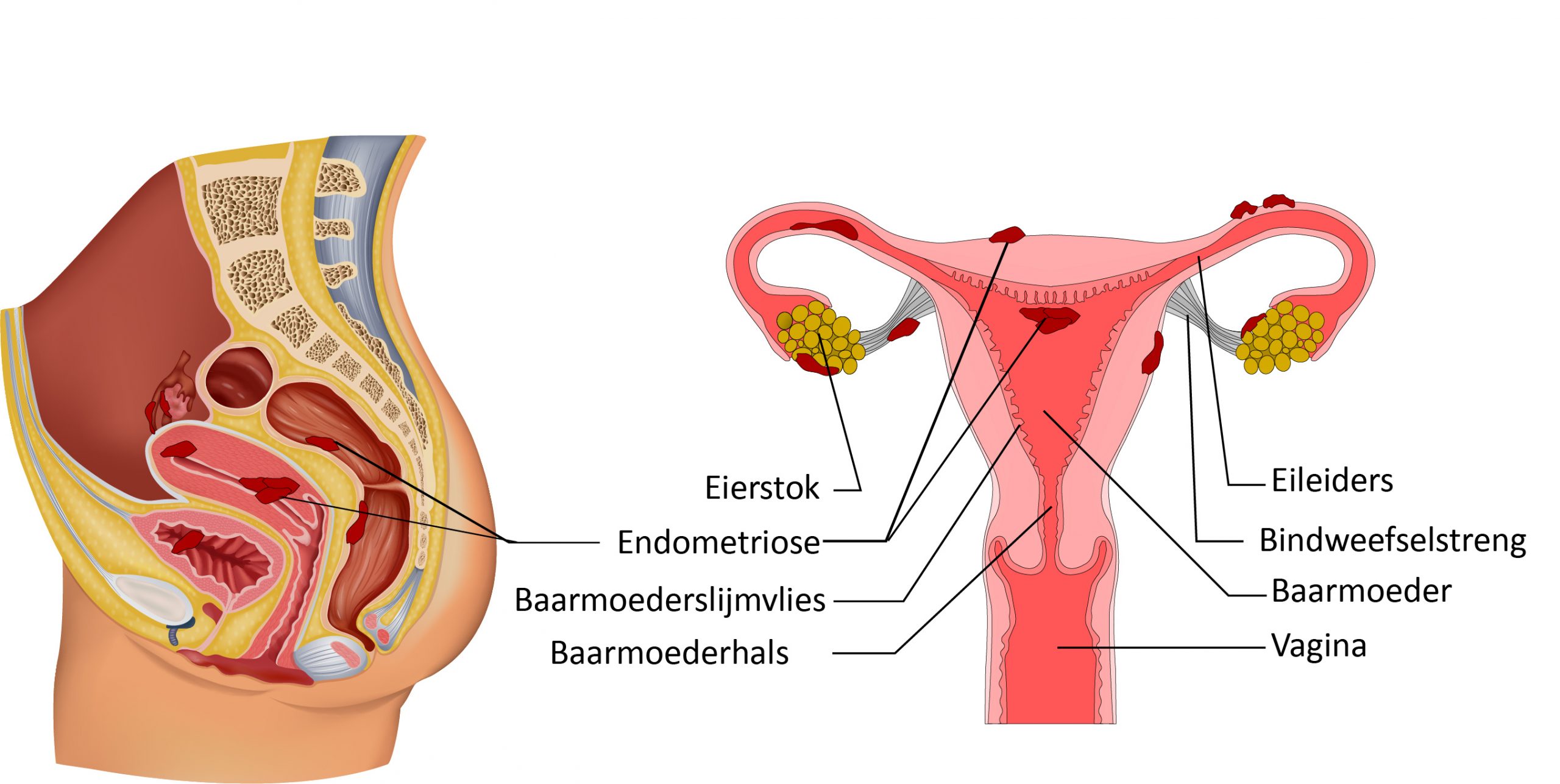Endometriose.jpg