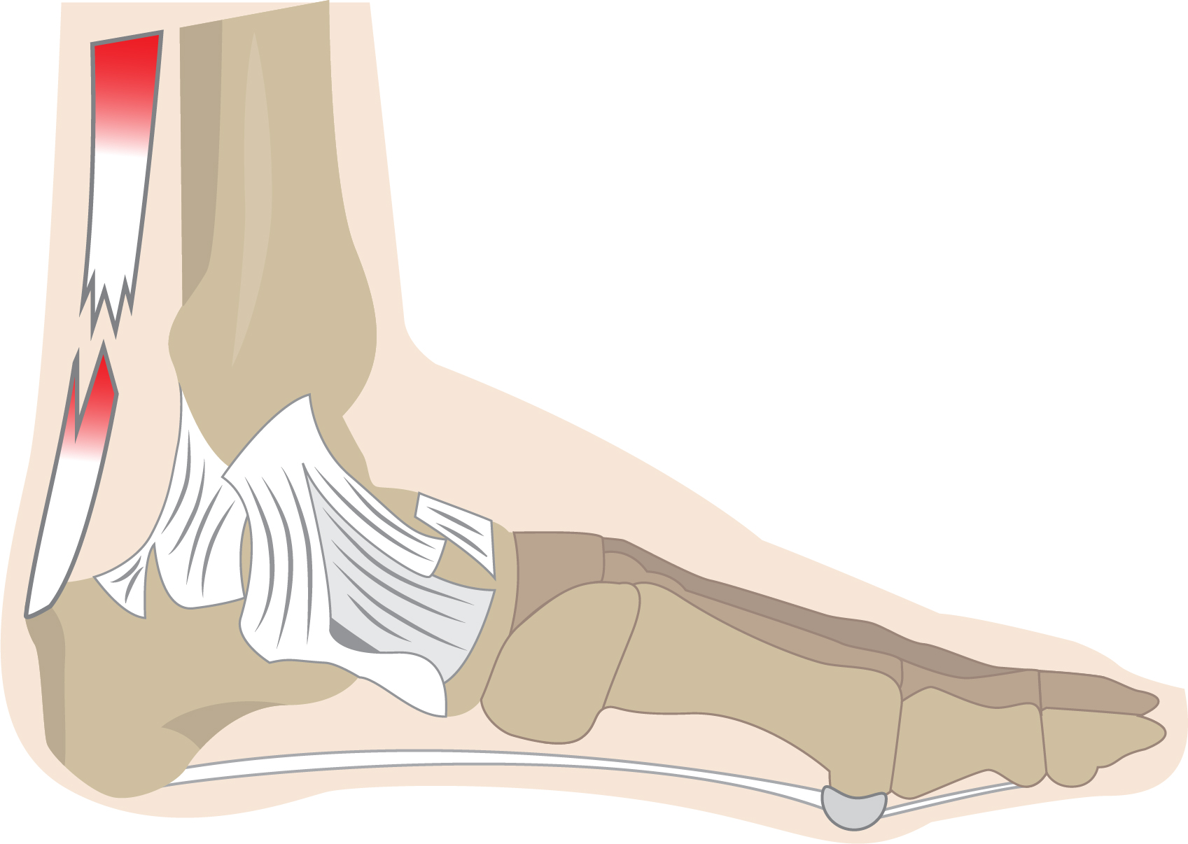 SEH achillespees.jpg