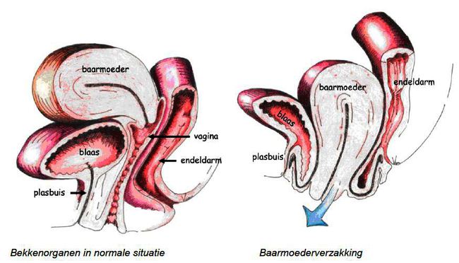 Afbeeldingen bekkenorganen en baarmoederverzakking.JPG