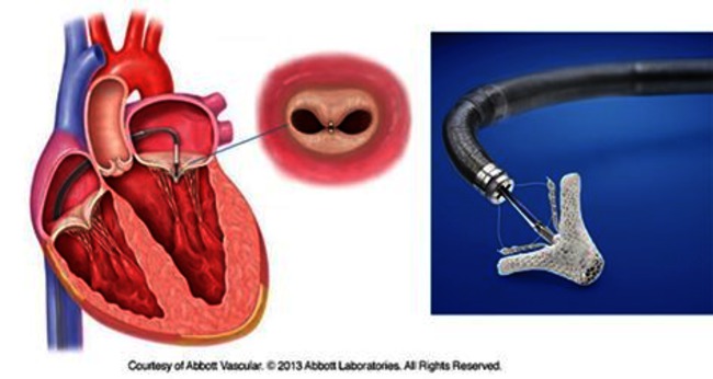 CAR-036 afbeelding Mitraclip.png