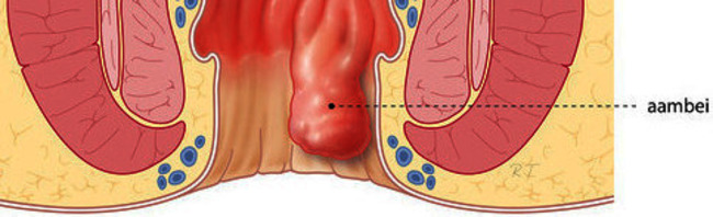 CHI059 Barron-ligatie bij aambeien 26-05-2014.jpg