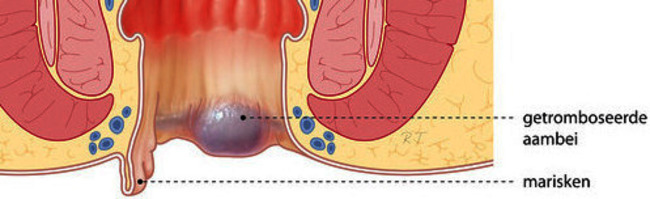 CHI061 Behandeling van marisken 27-05-2014 def.jpg
