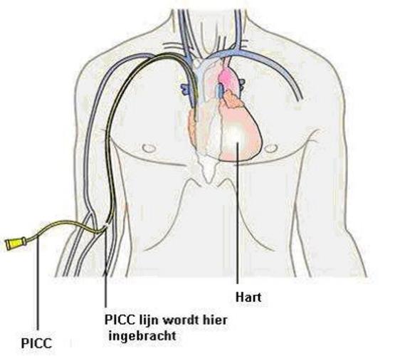 Foto PICC lijn.JPG