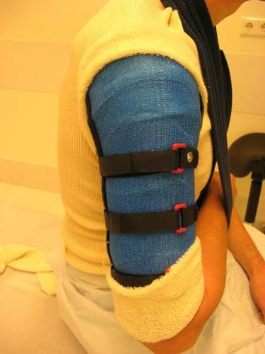 Humerus brace, figuur 1.JPG