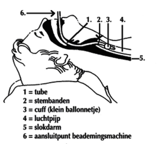 ICA-007 Kunstmatige beademing.png