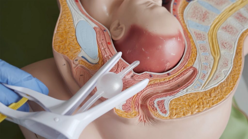 Verloskunde Inleiden