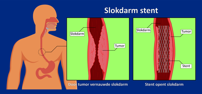 MDL-030 Stent oesophagus.jpg