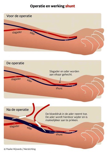 Nieren operatie shunt.png