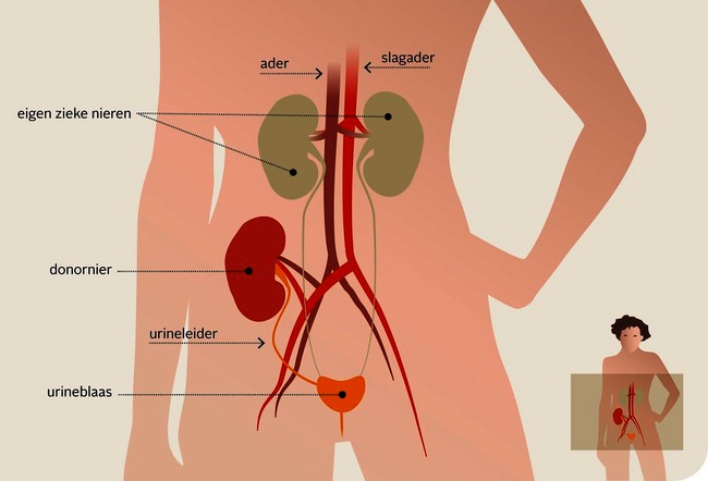 Niertransplantatie.png