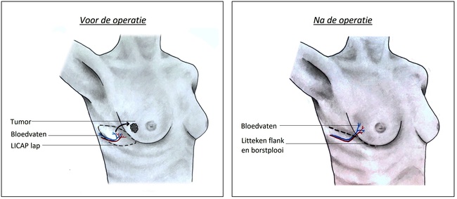 PLA-029 Licap lap voor en na Figuur 2.jpg
