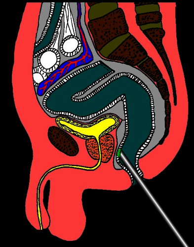 RTH-017 inwendige bestraling endeldarm kanker.jpg