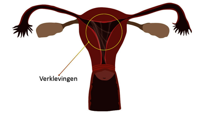 Verklevingen kleiner.jpg