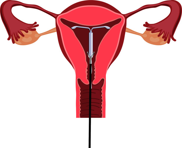 Verwijderen spiraaltje kleiner.jpg