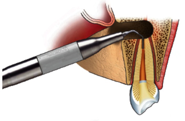 behandeling van een wortelpuntontsteking 4