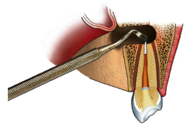 behandeling van een wortelpuntontsteking 5