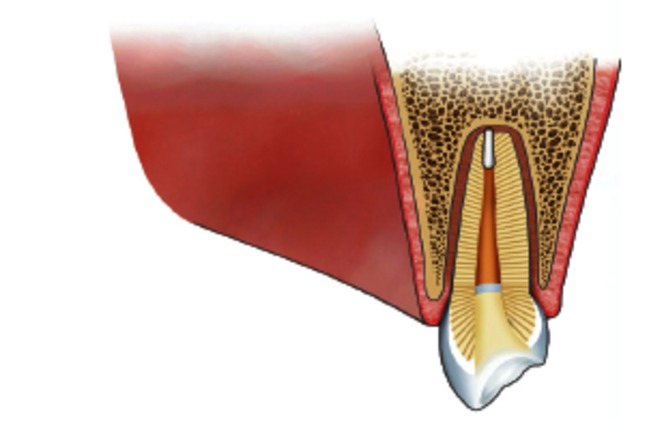behandeling van een wortelpuntontsteking 6