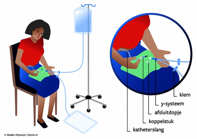 nieren CAPD.png
