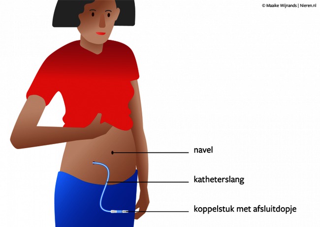 nieren Peritoneaal dialyse katheter.png