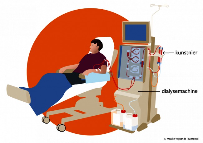 nieren hemodialyse 2.png