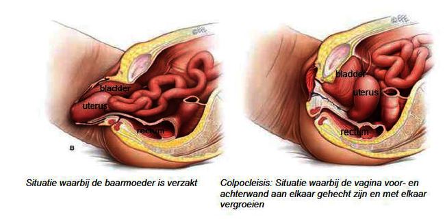 vaginale verzakking.JPG