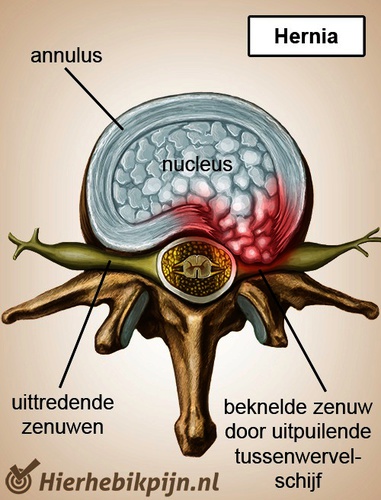wervelkolom-wervel-tussenwervelschijf-hernia-zenuwen.jpg