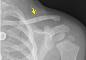 Fractured collarbone
