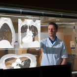 Goedaardige of kwaadaardige bolletjes in de longen? AI helpt de radioloog